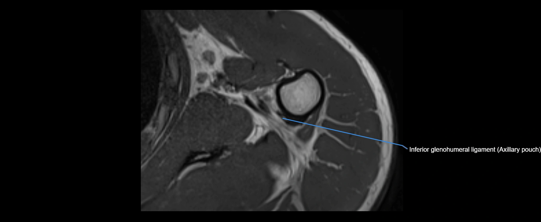 shoulder ligaments axial 3d 3t mri image-img-00005-00098.webp